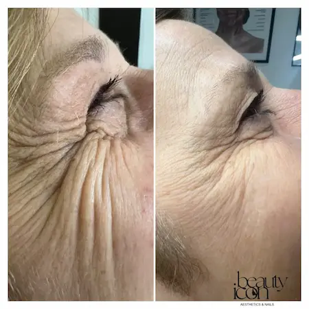 Stunning before and after results of anti-wrinkle treatment at beauty salon on crow's feet lines.