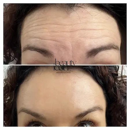 Before and after results of anti-wrinkle treatment on forehead lines at Beauty Icon Solihull.