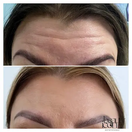 Comparison of forehead lines before and after anti-wrinkle treatment.