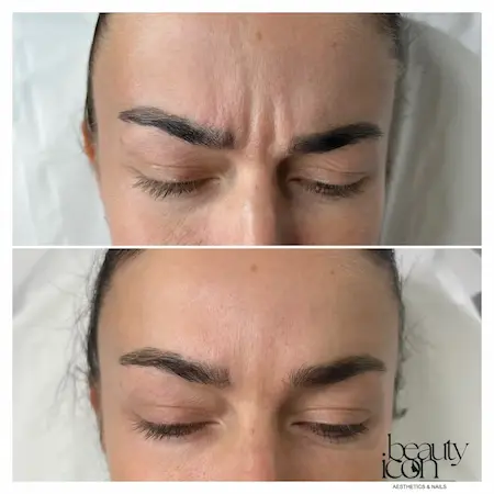 Comparison of frown lines before and after a flawless anti-wrinkle treatment.