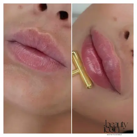 Lip filler treatment results: Visible volume increase and shape improvement.