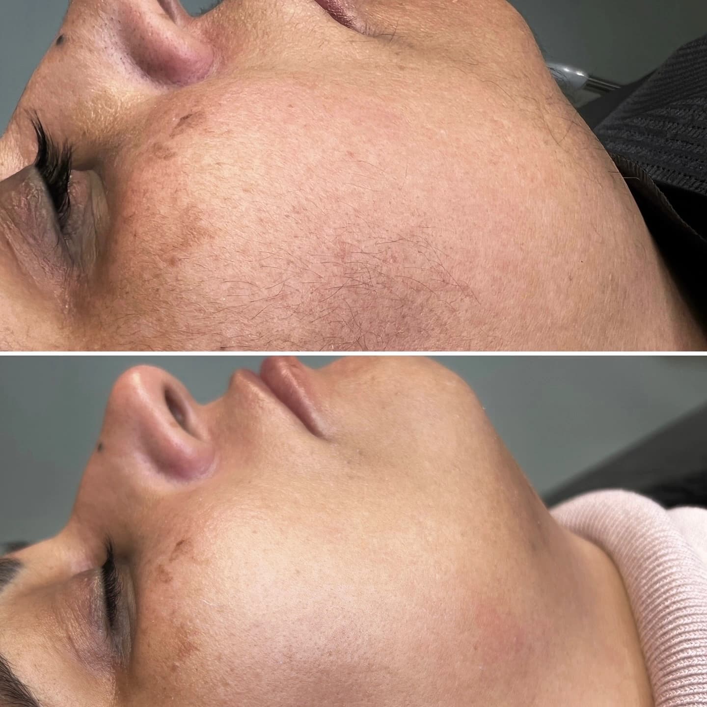 Skin texture improvement after micro-needling at Beauty Icon Solihull